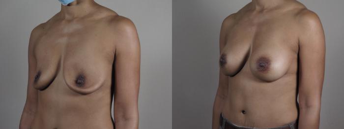 Breast Implant Revision Case 1204 Before & After View #2 | Paramus, New Jersey | Parker Center for Plastic Surgery