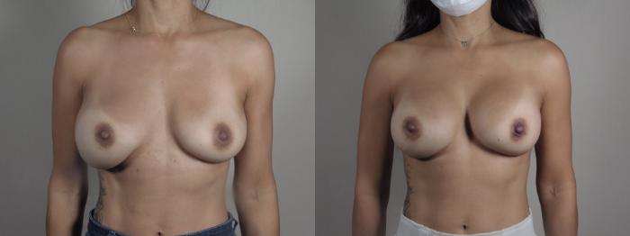 Breast Implant Revision Case 1220 Before & After View #1  | Paramus, New Jersey | Parker Center for Plastic Surgery