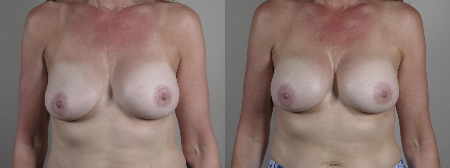Breast Implant Revision Case 1226 Before & After View #1  | Paramus, New Jersey | Parker Center for Plastic Surgery