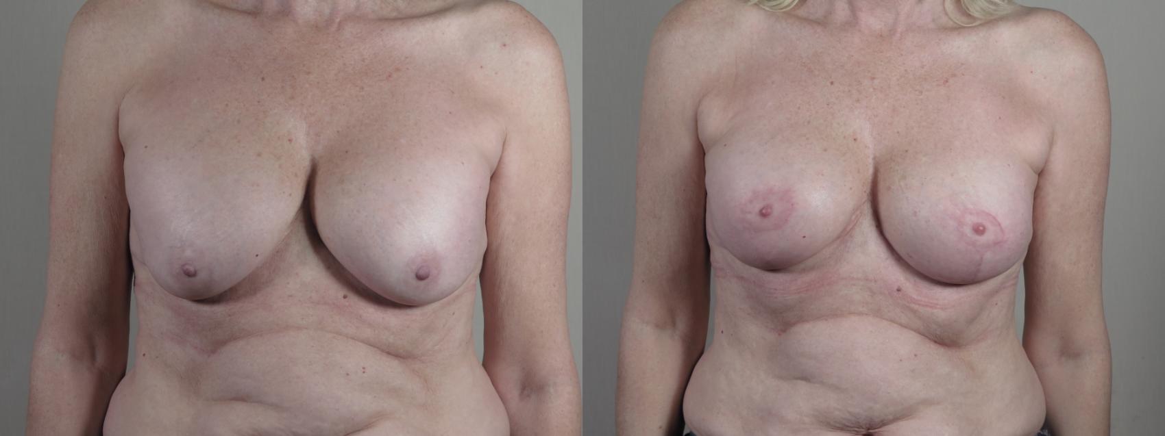 Breast Implant Revision Case 1324 Before & After Front | Paramus, New Jersey | Parker Center for Plastic Surgery