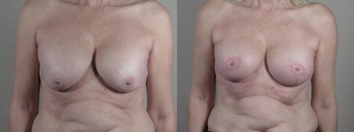 Breast Implant Revision Case 1324 Before & After Front | Paramus, New Jersey | Parker Center for Plastic Surgery
