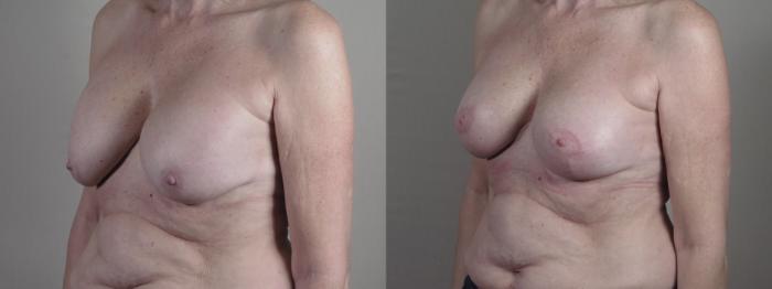 Breast Implant Revision Case 1324 Before & After Left Oblique | Paramus, New Jersey | Parker Center for Plastic Surgery