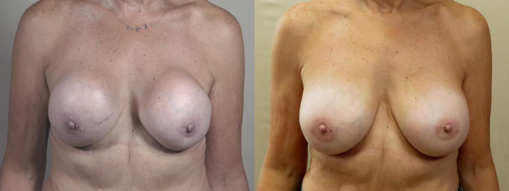 Breast Implant Revision Case 1377 Before & After Front | Paramus, New Jersey | Parker Center for Plastic Surgery