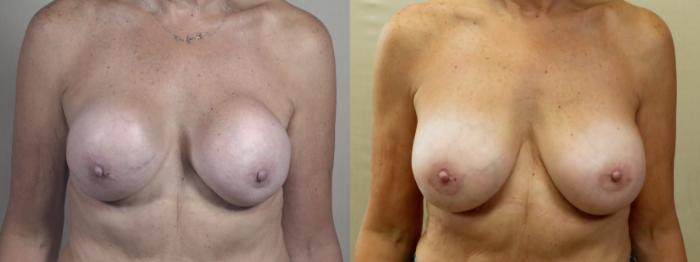 Breast Implant Revision Case 1377 Before & After Front | Paramus, New Jersey | Parker Center for Plastic Surgery