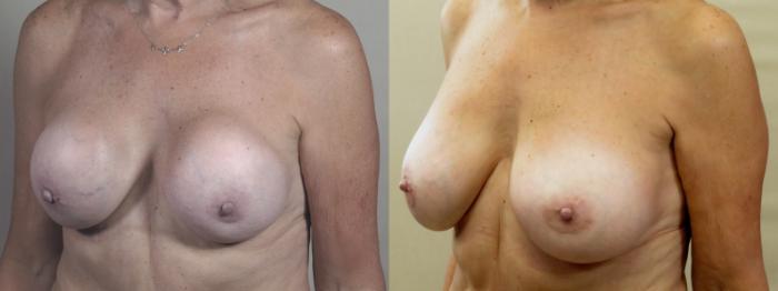 Breast Implant Revision Case 1377 Before & After Left Oblique | Paramus, New Jersey | Parker Center for Plastic Surgery