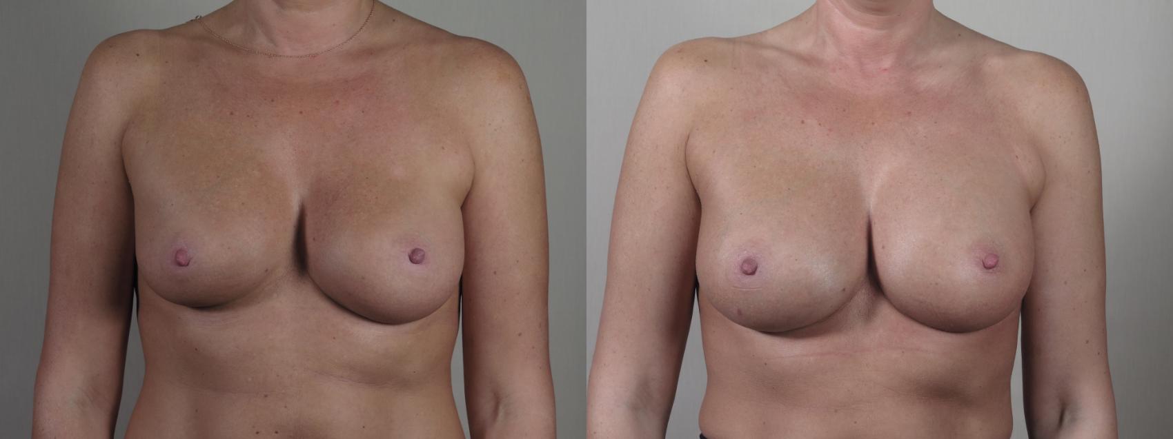 Breast Implant Revision Case 1413 Before & After Front | Paramus, New Jersey | Parker Center for Plastic Surgery