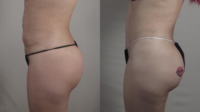 Breast Implant Revision Case 1504 Before & After Left Side | Paramus, New Jersey | Parker Center for Plastic Surgery