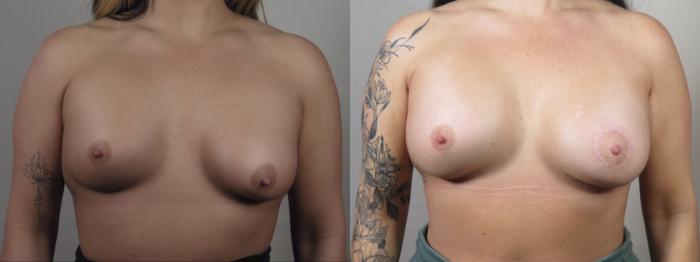 Breast Implant Revision Case 1532 Before & After Front | Paramus, New Jersey | Parker Center for Plastic Surgery