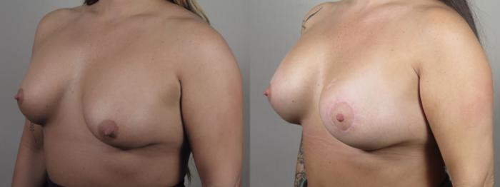Breast Implant Revision Case 1532 Before & After Left Oblique | Paramus, New Jersey | Parker Center for Plastic Surgery