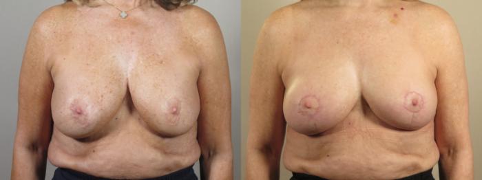 Breast Implant Revision Case 1560 Before & After Front | Paramus, New Jersey | Parker Center for Plastic Surgery