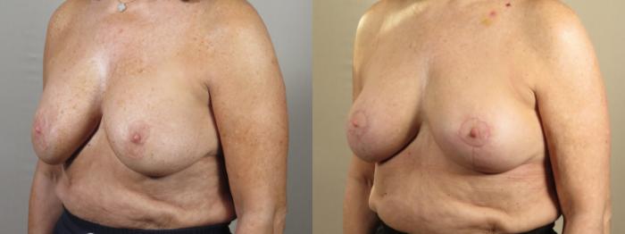 Breast Implant Revision Case 1560 Before & After Left Oblique | Paramus, New Jersey | Parker Center for Plastic Surgery