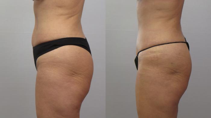 Breast Implant Revision Case 1654 Before & After 1 | Paramus, New Jersey | Parker Center for Plastic Surgery