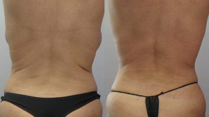 Breast Implant Revision Case 1654 Before & After 2 | Paramus, New Jersey | Parker Center for Plastic Surgery