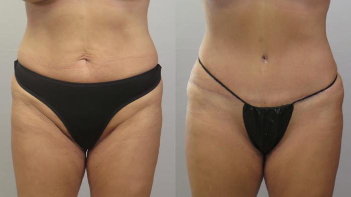 Breast Implant Revision Case 1654 Before & After Front | Paramus, New Jersey | Parker Center for Plastic Surgery