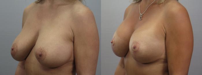 Breast Implant Revision Case 1654 Before & After Left Oblique | Paramus, New Jersey | Parker Center for Plastic Surgery