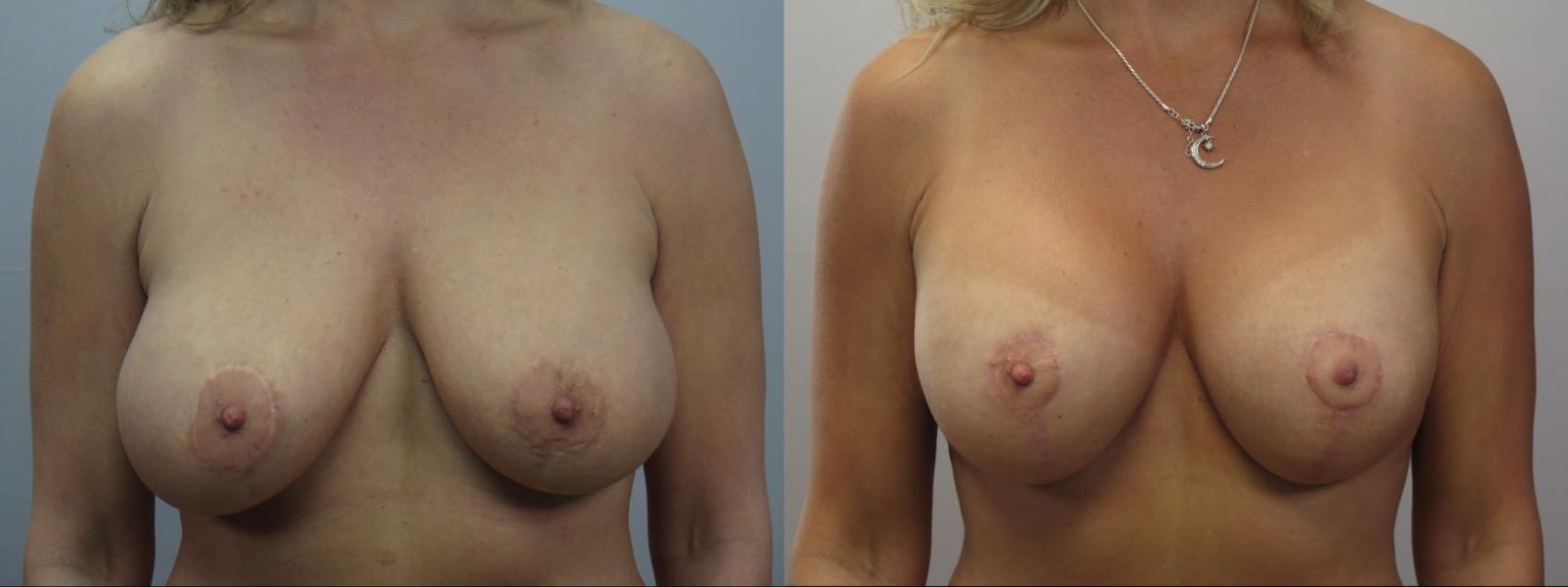 Breast Implant Revision Case 1654 Before & After Left Side | Paramus, New Jersey | Parker Center for Plastic Surgery