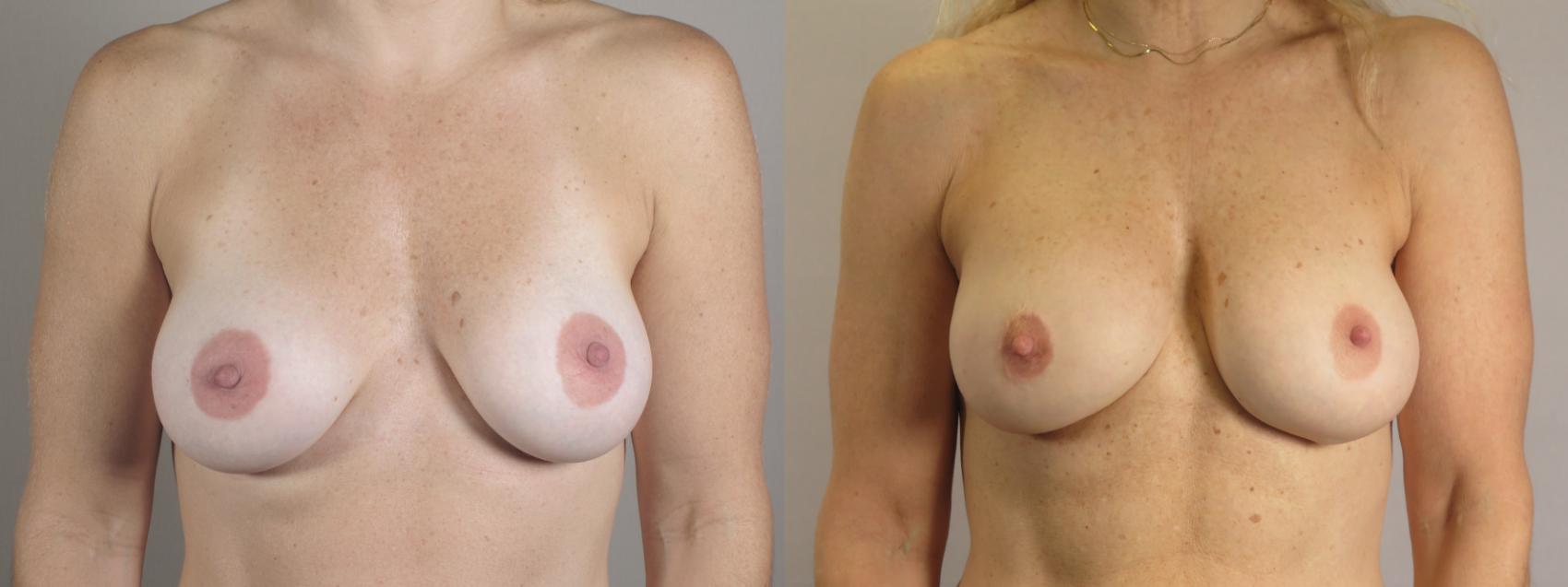 Breast Implant Revision Case 1663 Before & After Front | Paramus, New Jersey | Parker Center for Plastic Surgery