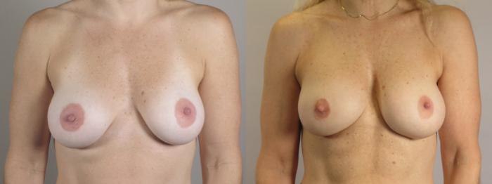 Breast Implant Revision Case 1663 Before & After Front | Paramus, New Jersey | Parker Center for Plastic Surgery
