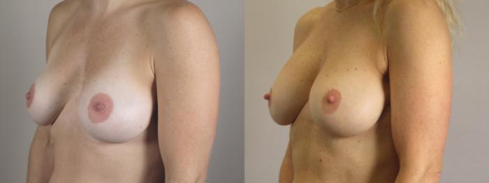 Breast Implant Revision Case 1663 Before & After Left Oblique | Paramus, New Jersey | Parker Center for Plastic Surgery