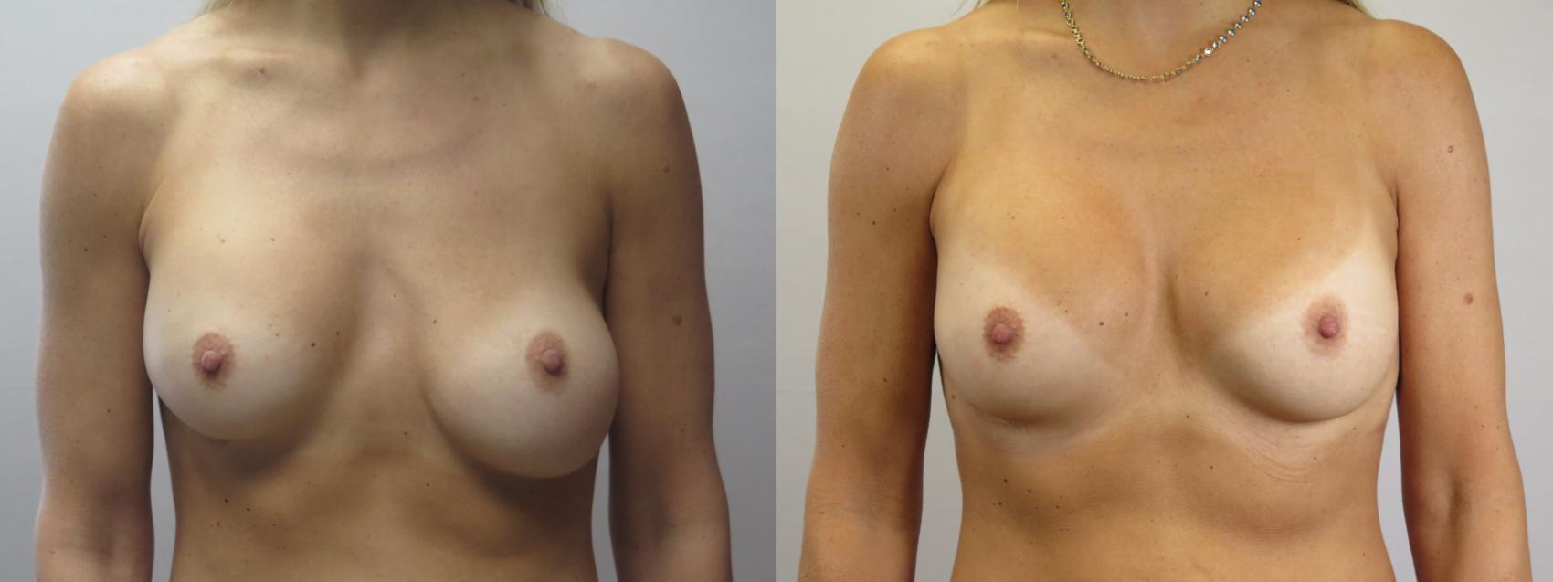 Breast Implant Revision Case 1665 Before & After Front | Paramus, New Jersey | Parker Center for Plastic Surgery