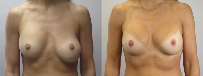 Breast Implant Revision Case 1665 Before & After Front | Paramus, New Jersey | Parker Center for Plastic Surgery