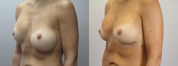 Breast Implant Revision Case 1665 Before & After Left Oblique | Paramus, New Jersey | Parker Center for Plastic Surgery