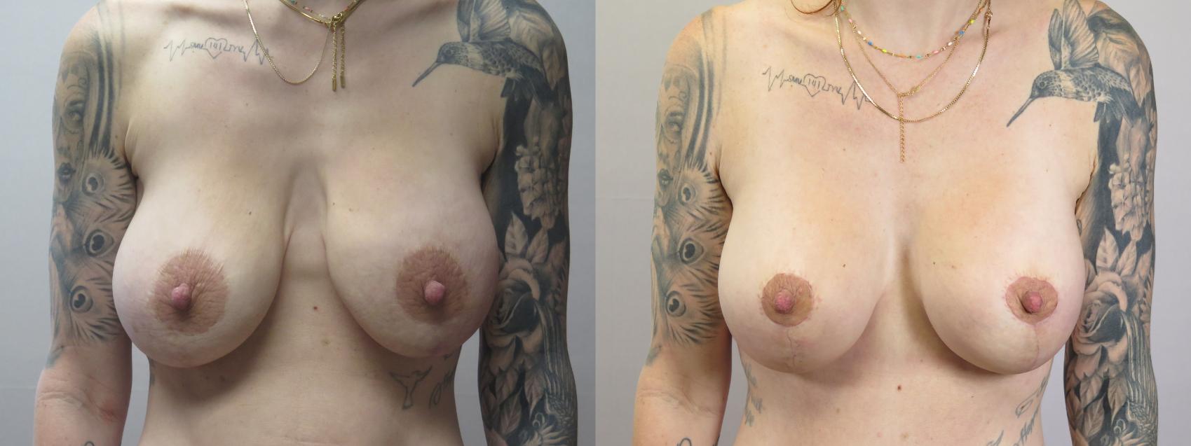Breast Implant Revision Case 1666 Before & After Front | Paramus, New Jersey | Parker Center for Plastic Surgery