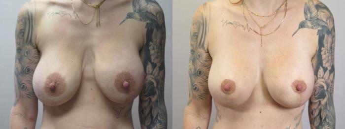 Breast Implant Revision Case 1666 Before & After Front | Paramus, New Jersey | Parker Center for Plastic Surgery