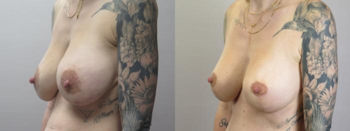 Breast Implant Revision Case 1666 Before & After Left Oblique | Paramus, New Jersey | Parker Center for Plastic Surgery