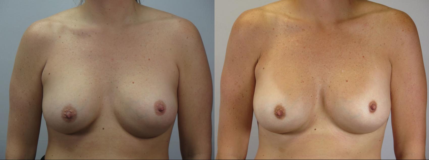 Breast Implant Revision Case 1674 Before & After Front | Paramus, New Jersey | Parker Center for Plastic Surgery