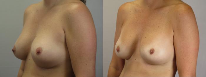 Breast Implant Revision Case 1674 Before & After Left Oblique | Paramus, New Jersey | Parker Center for Plastic Surgery