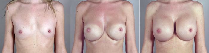 Breast Implant Revision Case 388 Before & After View #1 | Paramus, New Jersey | Parker Center for Plastic Surgery