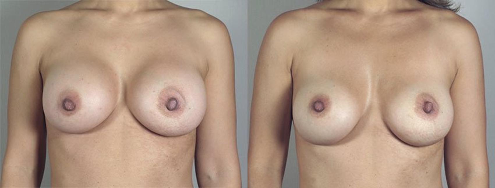 Breast Implant Revision Case 517 Before & After View #1 | Paramus, New Jersey | Parker Center for Plastic Surgery