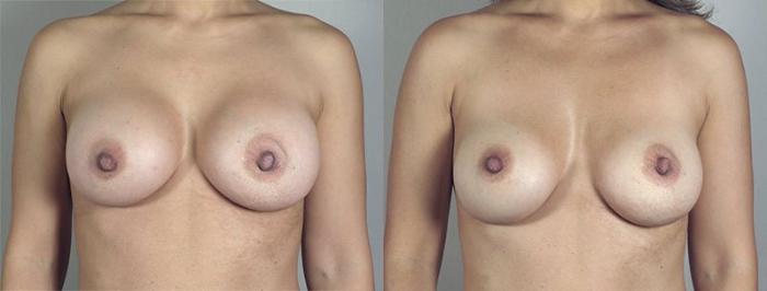 Breast Implant Revision Case 517 Before & After View #1 | Paramus, New Jersey | Parker Center for Plastic Surgery