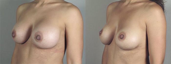 Breast Implant Revision Case 517 Before & After View #2 | Paramus, New Jersey | Parker Center for Plastic Surgery