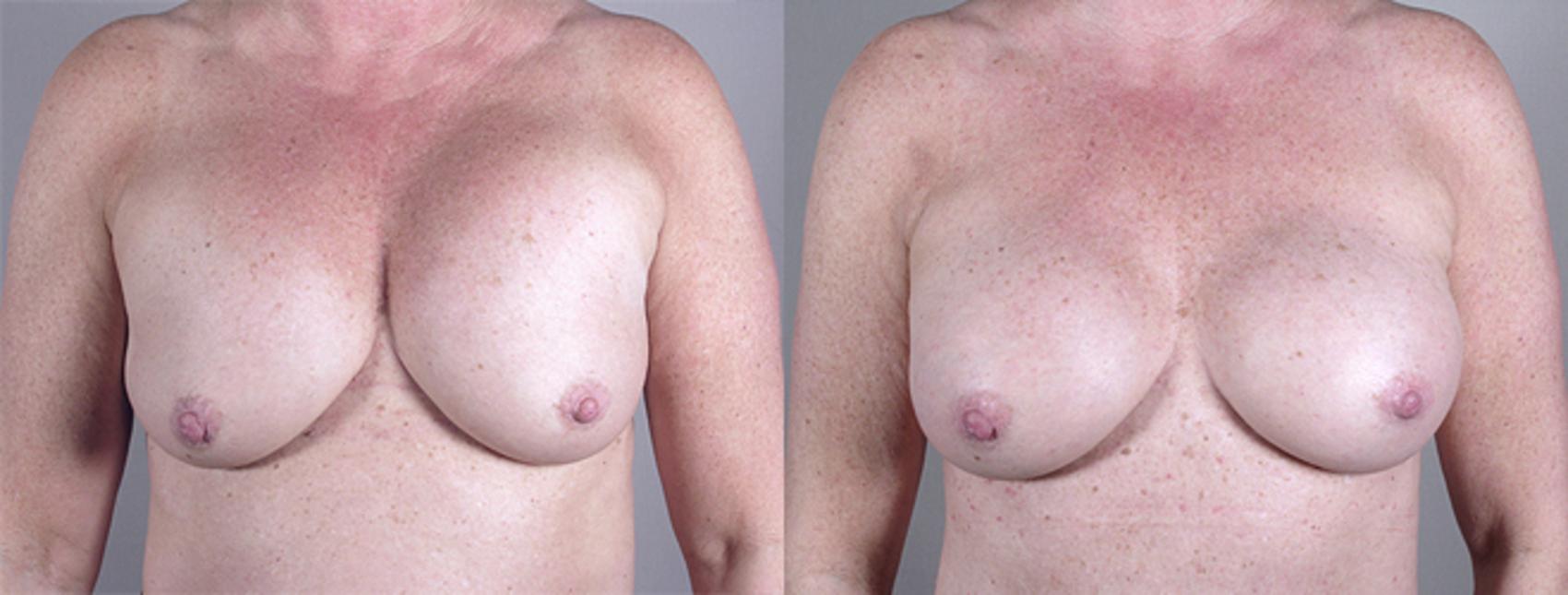 Breast Implant Revision Case 556 Before & After View #1 | Paramus, New Jersey | Parker Center for Plastic Surgery
