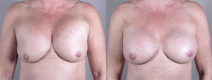Breast Implant Revision Case 556 Before & After View #1 | Paramus, New Jersey | Parker Center for Plastic Surgery