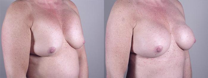 Breast Implant Revision Case 556 Before & After View #2 | Paramus, New Jersey | Parker Center for Plastic Surgery