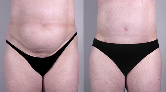 Breast Implant Revision Case 556 Before & After View #3 | Paramus, New Jersey | Parker Center for Plastic Surgery