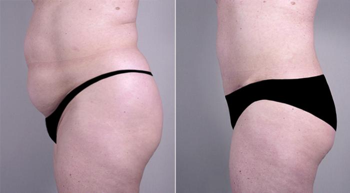 Breast Implant Revision Case 556 Before & After View #4 | Paramus, New Jersey | Parker Center for Plastic Surgery