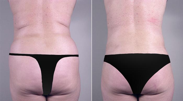 Breast Implant Revision Case 556 Before & After View #5 | Paramus, New Jersey | Parker Center for Plastic Surgery