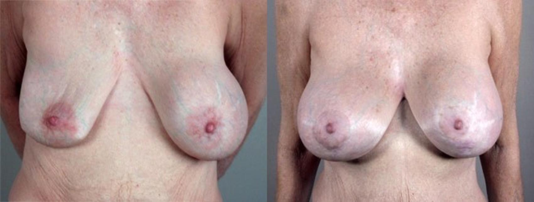 Breast Implant Revision Case 576 Before & After View #1 | Paramus, New Jersey | Parker Center for Plastic Surgery
