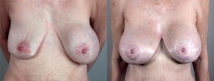 Breast Implant Revision Case 576 Before & After View #1 | Paramus, New Jersey | Parker Center for Plastic Surgery
