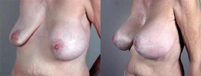 Breast Implant Revision Case 576 Before & After View #2 | Paramus, New Jersey | Parker Center for Plastic Surgery