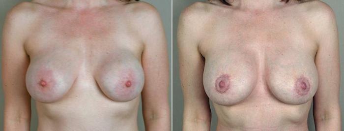 Breast Implant Revision Case 577 Before & After View #1 | Paramus, New Jersey | Parker Center for Plastic Surgery