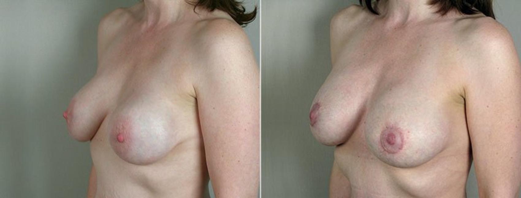 Breast Implant Revision Case 577 Before & After View #2 | Paramus, New Jersey | Parker Center for Plastic Surgery