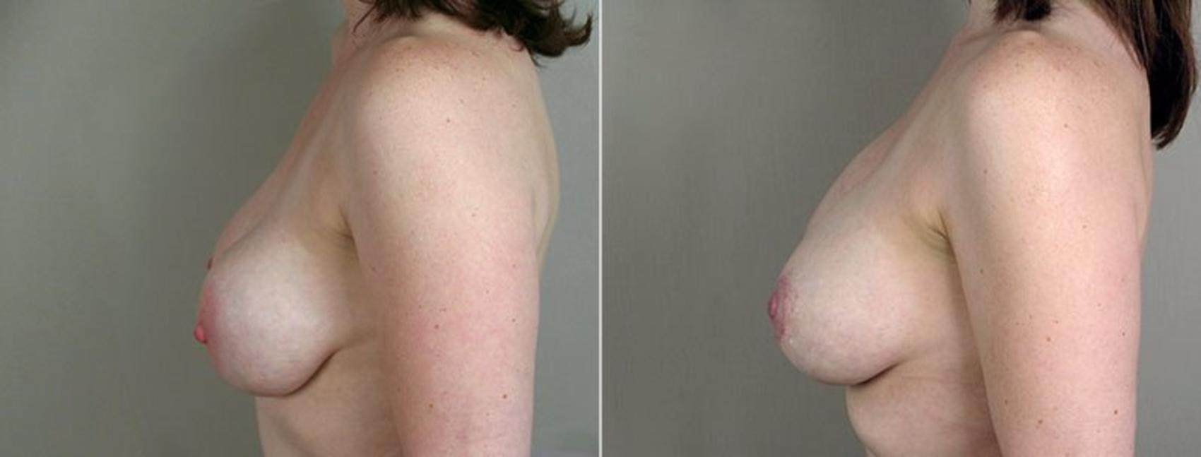 Breast Implant Revision Case 577 Before & After View #3 | Paramus, New Jersey | Parker Center for Plastic Surgery