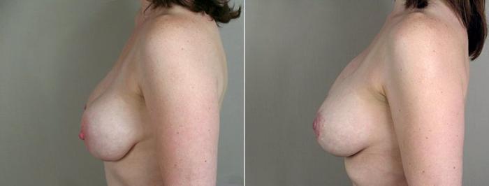 Breast Implant Revision Case 577 Before & After View #3 | Paramus, New Jersey | Parker Center for Plastic Surgery