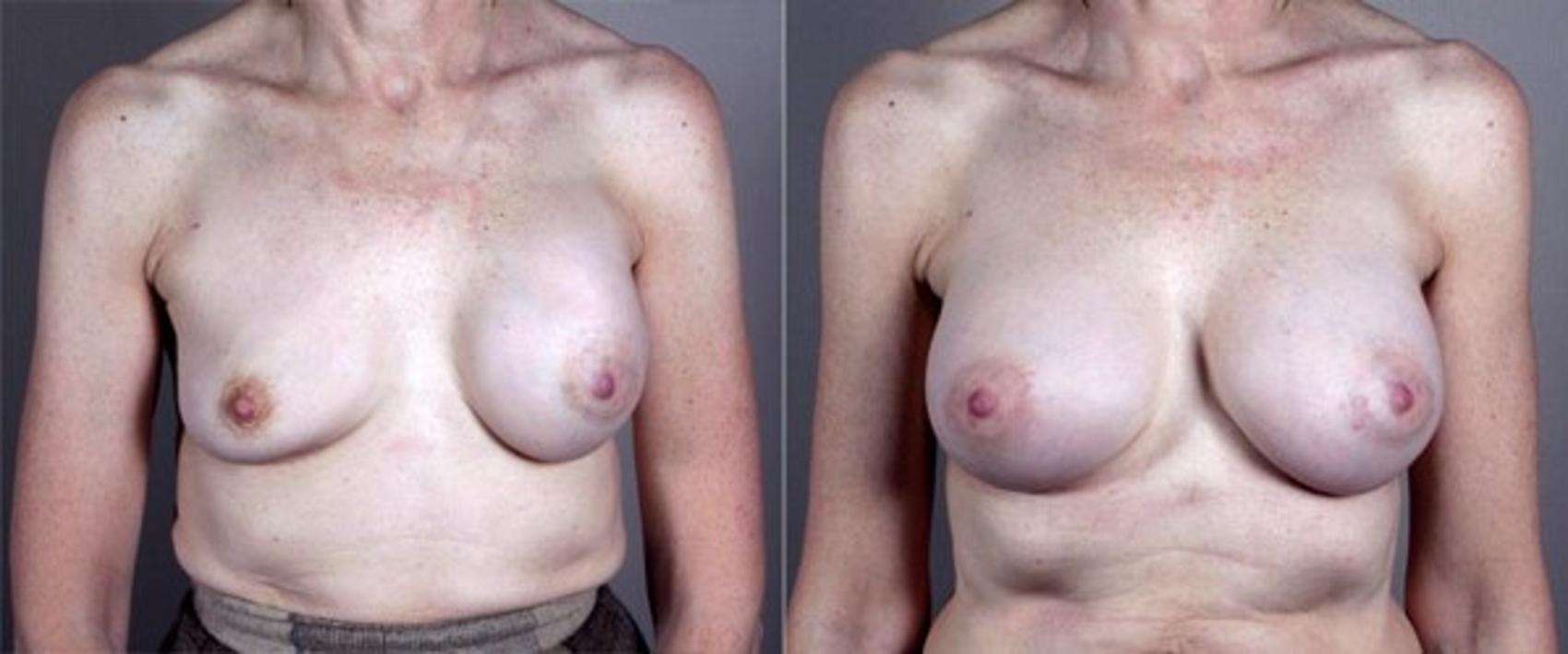 Breast Implant Revision Case 579 Before & After View #1 | Paramus, New Jersey | Parker Center for Plastic Surgery
