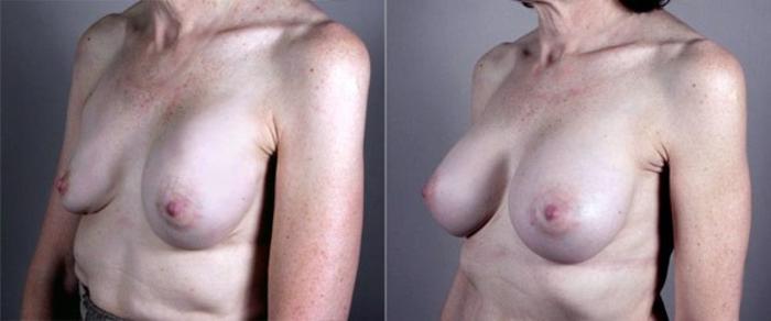 Breast Implant Revision Case 579 Before & After View #2 | Paramus, New Jersey | Parker Center for Plastic Surgery